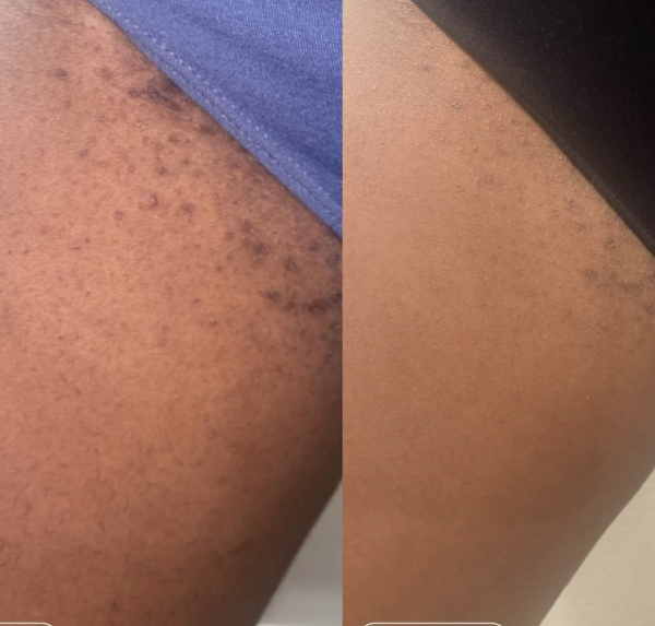 TOPICALS Roller Ingrown Hair AHA BHA Wurus Beauty Dakar